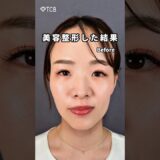 【糸リフト】美容整形した結果#shorts