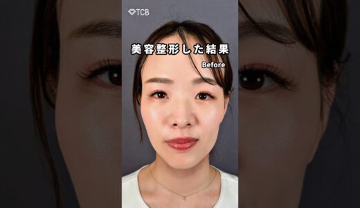 【糸リフト】美容整形した結果#shorts