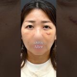 美容整形は不自然になりそうで嫌だ。そんな方に見ていただきたいです。 #美容
