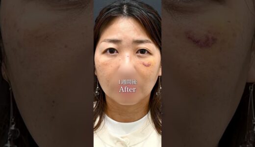 美容整形は不自然になりそうで嫌だ。そんな方に見ていただきたいです。 #美容