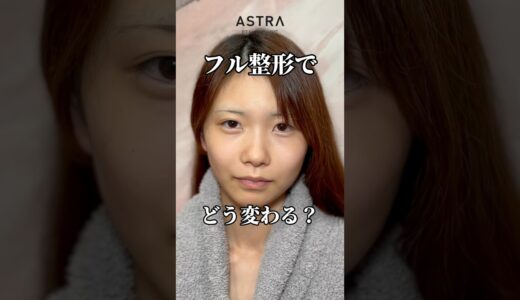 フル整形したら、、🥹💖#astrabeautyclinic  #アストラビューティークリニック #塩満恵子 #鼻整形 #美容整形 #忘れ鼻