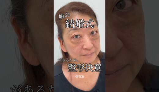 【クマ取り】娘の結婚式があるため、整形決意#shorts
