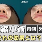 【美容整形】小鼻を小さくしたい方必見。鼻翼を切る方法は色々ある？効果とは｜ヴェリテクリニック