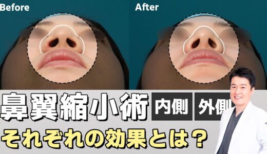 【美容整形】小鼻を小さくしたい方必見。鼻翼を切る方法は色々ある？効果とは｜ヴェリテクリニック