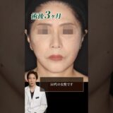 【症例紹介】50代女性のフェイスリフト、ペリカン手術を受けた方です #shorts #フェイスリフト #若返り