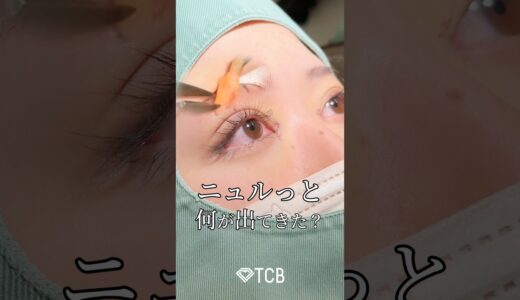 【二重整形】ニュルっと何が出てきた？#shorts