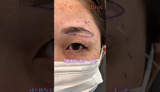 傷跡を目立たせない🪡#美容整形 #アンチエイジング