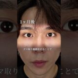 【クマ取り】自然に明るく変わる！#shorts #美容整形 #美容 #整形 #クマ取り