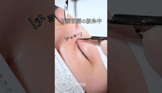 【二重整形】目頭切開、実際の傷はどのくらい？#shorts