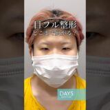 【目フル整形】衝撃のビフォーアフター#shorts