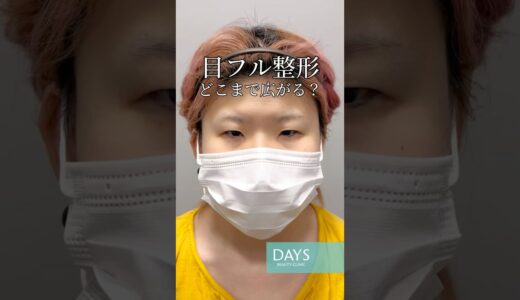 【目フル整形】衝撃のビフォーアフター#shorts