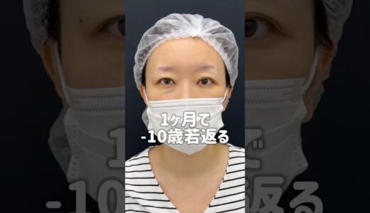 裏ハムラだけでこんなに変わる⁉️#美容整形 #クマ取り