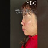 【念願】念願の鼻整形したら…#鼻整形 #美容整形 #整形 #美容 #ybc横浜美容外科