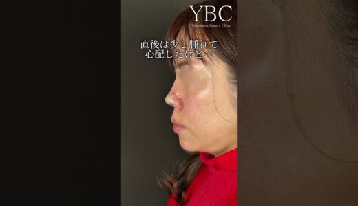 【念願】念願の鼻整形したら…#鼻整形 #美容整形 #整形 #美容 #ybc横浜美容外科