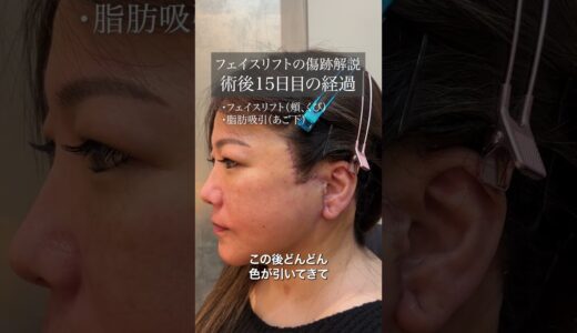 【切開/フェイスリフトの傷跡解説】術後15日目の経過（40代女性）