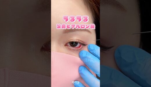 【美容整形】うるうる涙袋ヒアルロン酸💞 #shorts
