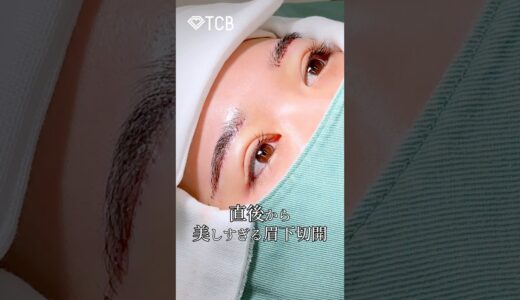 【美容整形】直後から美しすぎる眉下切開#shorts