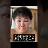 壮絶ダウンタイムを全て公開☆ #眉下切開 #眉下リフト #ハムラ法
