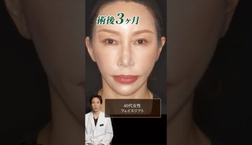 【症例解説】40代女性お顔のたるみをフェイスリフトで解決