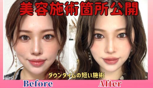 【美容整形】最近顔が垢抜けた理由を教えます‼️