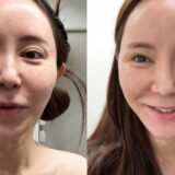 【美容整形】美容外科がオススメするテスリフト受けてみた