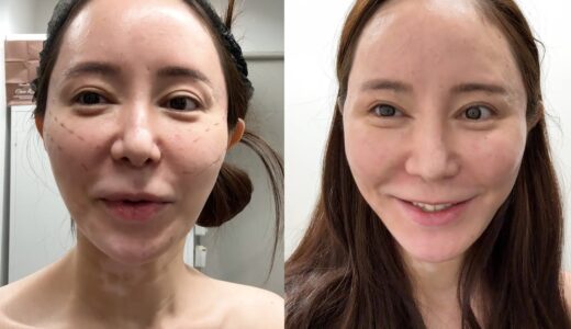 【美容整形】美容外科がオススメするテスリフト受けてみた