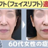 【顔のたるみ】フェイスリフト適応有かこれで分かる！ #Shorts