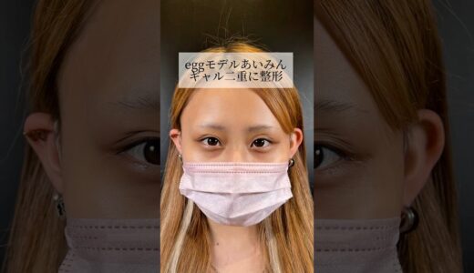 【二重整形】#shorts eggモデルがギャル二重に