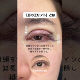 目の上リフトって知ってる？ #あいこ先生 #美容整形 #二重切開 #目の上リフト