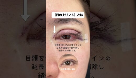 目の上リフトって知ってる？ #あいこ先生 #美容整形 #二重切開 #目の上リフト