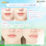 人中美容整形 : 施術対象&手術方法 1~8 PART{２}　#韓国美容整形　#渡韓　#人中短縮　#人中長い　#リップリフト　#口角　#中顔面　#小顔　#童顔　#Cカールリップ　#Eライン　#溝の形