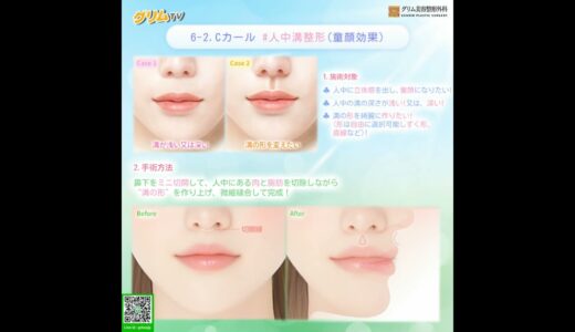 人中美容整形 : 施術対象&手術方法 1~8 PART{２}　#韓国美容整形　#渡韓　#人中短縮　#人中長い　#リップリフト　#口角　#中顔面　#小顔　#童顔　#Cカールリップ　#Eライン　#溝の形