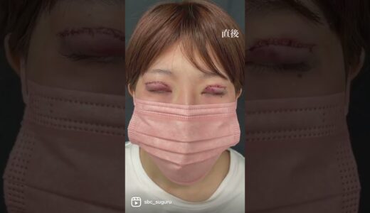 【勇気を出して目を切開した結果】#湘南美容クリニック#切開法 #ダウンタイム #二重整形 #二重整形経過#二重になりたい