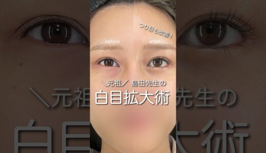 白目拡大術で加工級の変化 #shorts #美容 #整形