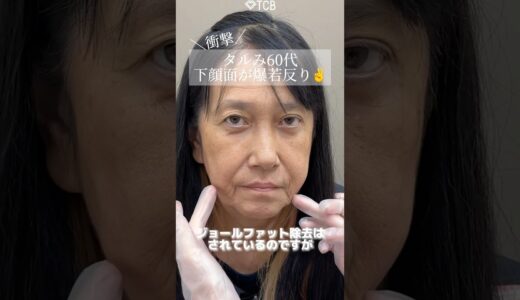 【糸リフト】たるみ60代奇跡級の若返り？#shorts
