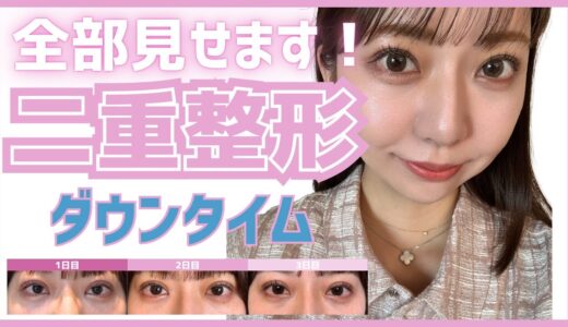 3ヶ月間の二重整形ダウンタイムを全部見せます！ 【名古屋×二重埋没】