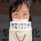 切らないクマ治療で何歳若返る？#美容 #美容整形 #ybc横浜美容外科 #イソセン#クマ取り #目の下のたるみ取り #目の下のたるみ取り