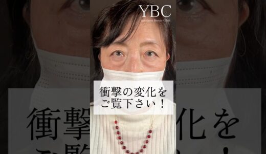 切らないクマ治療で何歳若返る？#美容 #美容整形 #ybc横浜美容外科 #イソセン#クマ取り #目の下のたるみ取り #目の下のたるみ取り