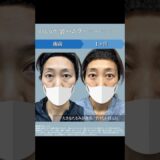 湘南No.1の裏ハムラ😎 #クマ取り #美容整形 #目の下のふくらみ取り #美容 #目の下のクマ取り #整形 #裏ハムラ法 #ダウンタイム