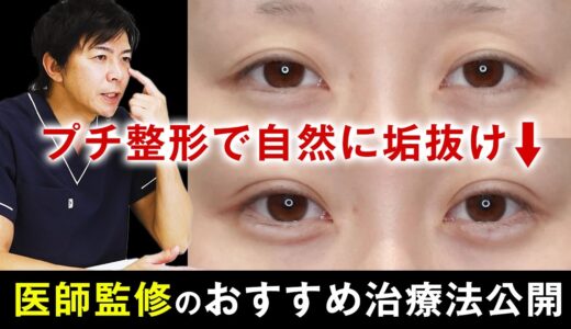 【二重整形】美容初心者におすすめ！自然に垢抜けるプチ整形２選【水の森美容クリニック】#二重埋没法#涙袋のヒアルロン酸