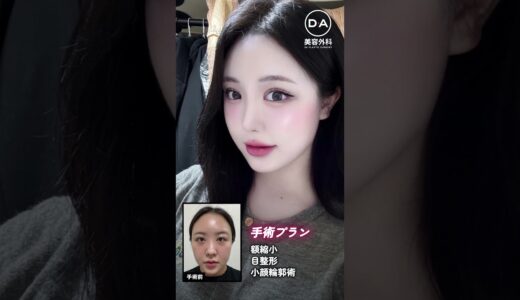 ［韓国整形］私もKpopアイドルみたいになれる？［DA美容外科]