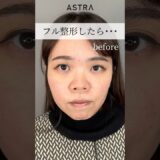 フル整形で、、😳💖#astrabeautyclinic  #アストラビューティークリニック #塩満恵子 #鼻整形 #美容整形 #忘れ鼻