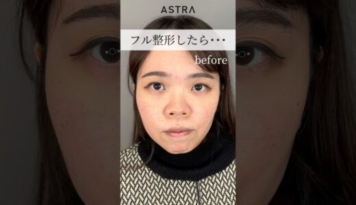 フル整形で、、😳💖#astrabeautyclinic  #アストラビューティークリニック #塩満恵子 #鼻整形 #美容整形 #忘れ鼻