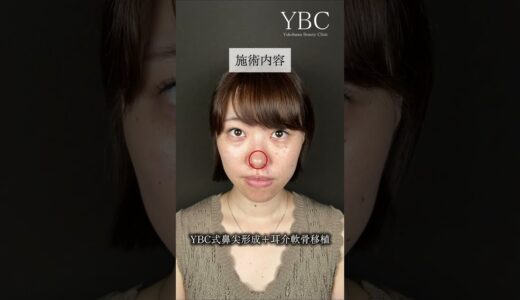 念願の鼻整形したら… #美容整形 #整形 #鼻整形