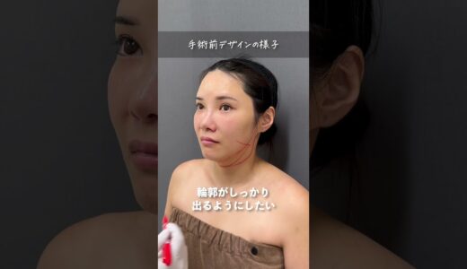 顎下脂肪吸引で別人級のフェイスラインに！#shorts
