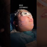 顎下脂肪吸引した結果‼️#美容整形