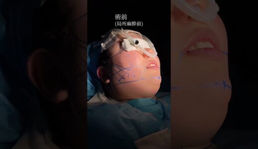 顎下脂肪吸引した結果‼️#美容整形