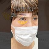２０歳若返る！？目元治療#美容 #美容整形 #イソセン#ybc横浜美容外科 #目の下のたるみ取り #目の下のクマ #若返り #眉下リフト