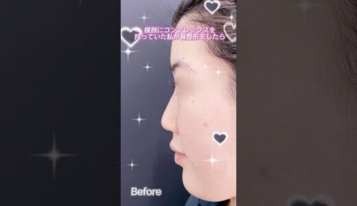 鼻フル整形👀　#形成外科専門医 #美容整形 #鼻整形 #美容 #整形 #垢抜け #鼻 #鼻フル