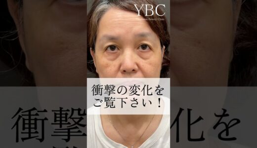 驚きのBeforeAfter#美容 #美容整形 #イソセン#ybc横浜美容外科 #目の下のたるみ取り #目の下のクマ #若返り